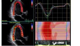 Vivid iq: Automated Function Imaging