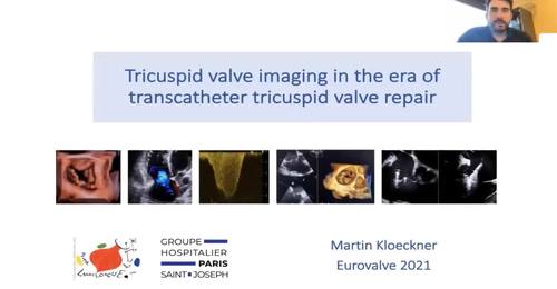 Tricuspid valve imaging in the era of transcatheter tricuspid valve repair