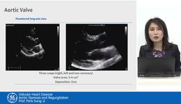 3. Aortic Valve Disease