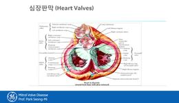4. Mitral Valve Disease
