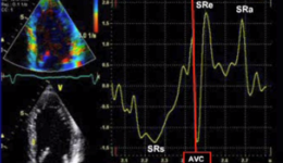 Webinar: Echocardiographic Strain Imaging