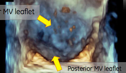 Vivid E9: Mitral valve acquisition 