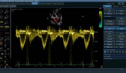 Vivid E95, E90, S70N, S60N and iq: Cardiac Auto Doppler