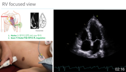Right Ventricle 기능 평가를 위한 영상