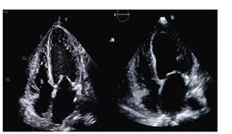 New Software Beamforming Algorithm is Superior to Standard Hardware-Based Beamformer in Endocardial Border Detection