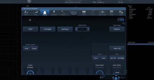 Vivid Tutorial Series Configuring Measurements Part 3 