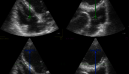 Vivid E95 and EchoPAC Software: TomTec RV Volume V2 Analysis